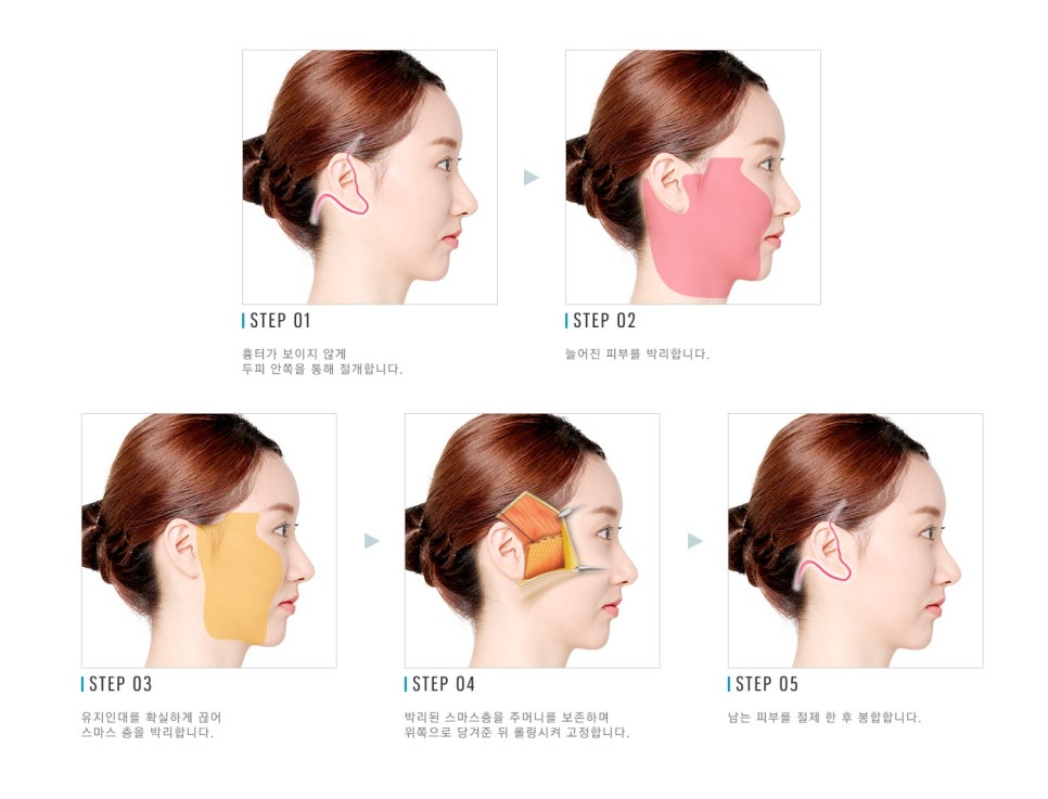 미니거상과 전체 안면거상, 나에게 맞는 안면거상술은? 관련 이미지 3