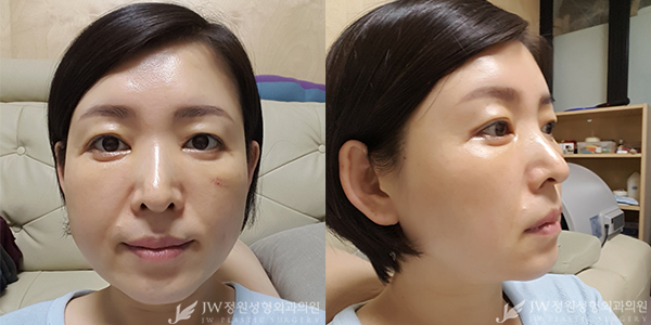 세월의 흔적 JW정원성형외과 이마눈썹거상+리와인드하안검으로 말끔하게♡ 관련 이미지 2