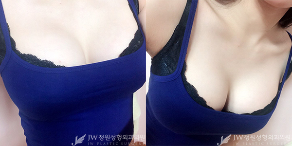 완벽한 볼륨감♥ 아름다운 모양까지♡ JW정원성형외과에서 자신감 되찾기! 관련 이미지 5