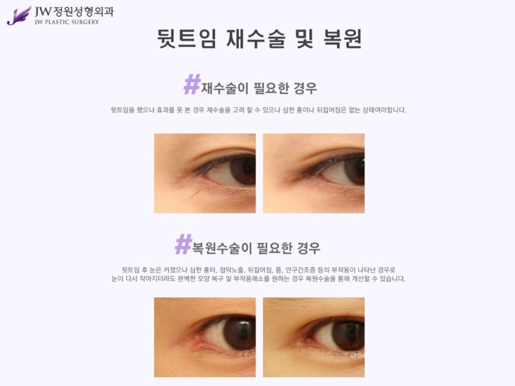 [JW정원성형외과] 앞뒷트임 재수술.복원 알아본다면? 트임복원 잘하는 곳에서! 관련 이미지 5