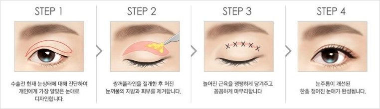 [JW정원성형외과] 처진 눈꺼풀 늘어진 지방과 주름 제거 상안검 수술로 해결 관련 이미지 2