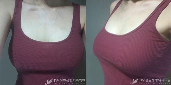 비대칭, 처진가슴 교정도 역시 JW정원성형외과에서! 관련 이미지 2