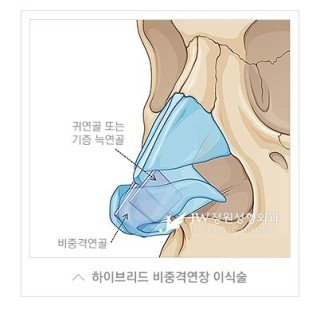 내 얼굴의 중심, 황금비율로! JW정원성형외과 짧은코성형 관련 이미지 5