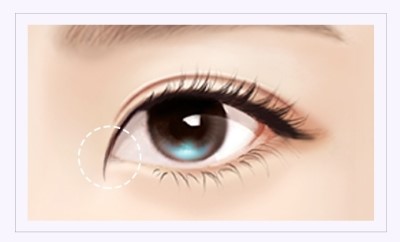 답답한 눈매를 시원하고 자연스럽게! JW정원 앞트임 성형 관련 이미지 2