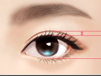 정확한 원인 판단과 시술로 완성하는 JW정원성형외과 눈재수술 관련 이미지 3