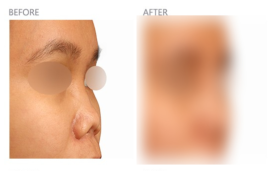 Collapsed Nose Revision Surgery, Safe Without Rejection Using Autologous Rib Cartilage! image 2