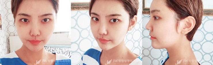 울퉁불퉁한 얼굴라인&rarr;JW정원지방이식으로 매끈하게! 관련 이미지 2