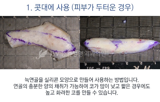 자연스러운 콧대! 견고한 코끝! JW정원성형외과 늑연골 코성형 관련 이미지 5
