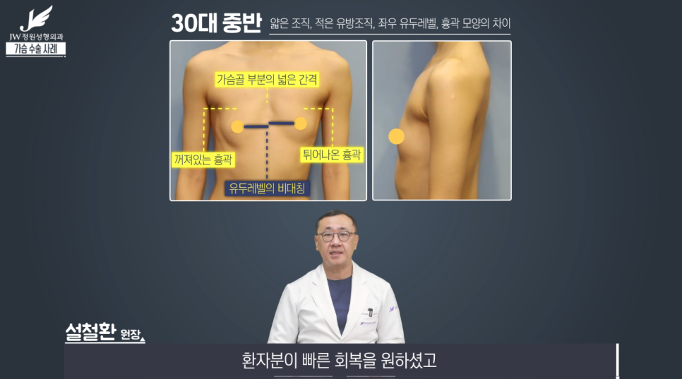 가슴성형수술전후 개인별 맞춤으로 꼼꼼하게! 【강남 JW정원성형외과】 관련 이미지 4