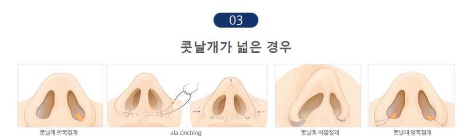 촌스러움 노노! 세련된 라인, JW정원성형외과 콧볼축소 관련 이미지 8