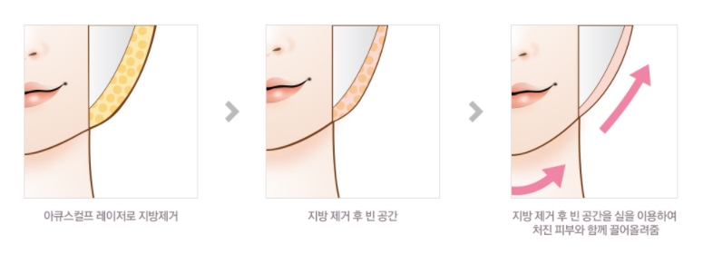 JW정원성형외과 더블리프팅(아큐스컬프&실리프팅)으로 피부 탄력과 브이라인 효과까지 더블로! 관련 이미지 7