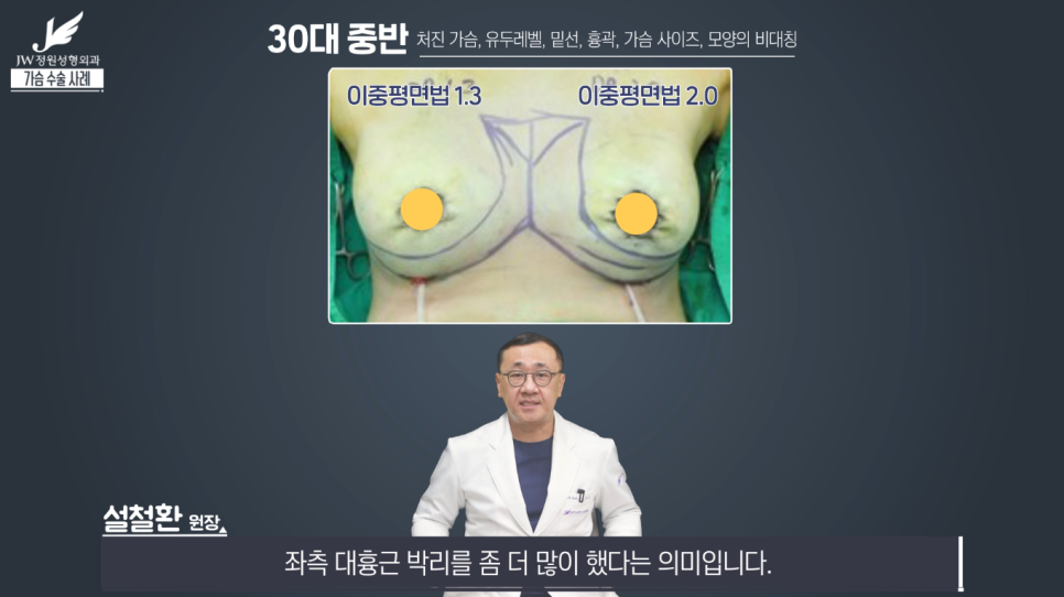 처진가슴교정 치밀한 계획으로 완성도는 UP! 【강남 JW정원성형외과】 관련 이미지 10