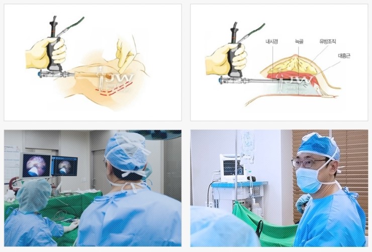 보형물+지방이식 장점만을 담은 JW정원성형외과 콤비네이션 가슴확대 관련 이미지 5