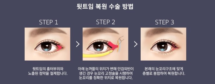 트임 재수술, 복원수술도 역시 JW정원성형외과! 관련 이미지 8