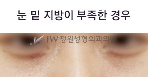 Best Place for Under-Eye Fat Repositioning, with a Surgical Method Suited to My Under-Eyes image 3