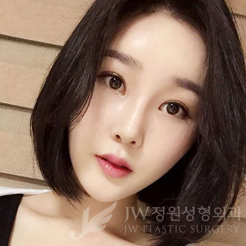 이마눈썹리프팅,눈매교정술,앞트임복원,코성형,지방이식 &rArr; JW정원성형외과에서! 관련 이미지 10