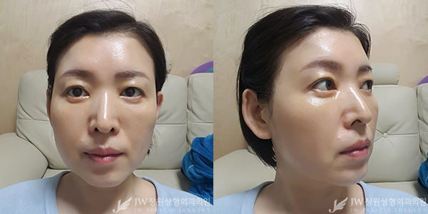 세월의 흔적 JW정원성형외과 이마눈썹거상+리와인드하안검으로 말끔하게♡ 관련 이미지 3
