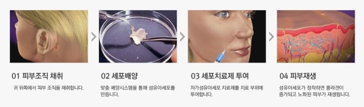 JW정원성형외과 큐어스킨으로 자연스럽고 오래오래 동안효과!! 관련 이미지 2