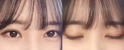 감으면 사라지고 뜨면 나타나는 다이나믹폴드(Dynamic Fold) JW정원성형외과 쌍꺼풀 수술 관련 이미지 6