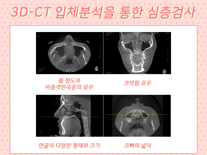 A Deviated Nose, Beautiful Nose Line, and Rhinoplasty with Nasal Obstruction Surgery All at Once! image 4