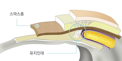 JW정원성형외과 안면거상술▶ 스마스조각리프팅이란? 관련 이미지 8