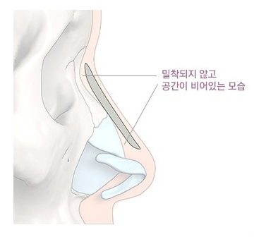 After JW Garden 3D Rhinoplasty, a Custom-Designed Nose Line image 2