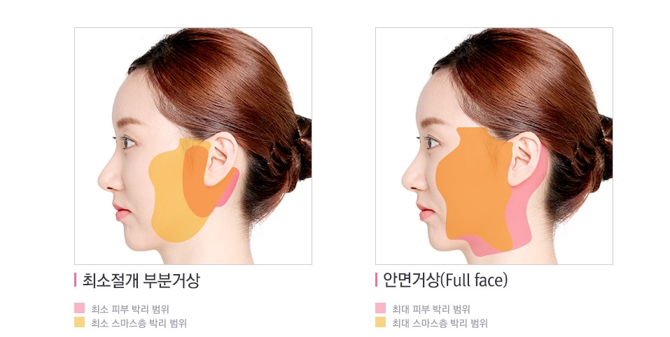 미니거상과 전체 안면거상, 나에게 맞는 안면거상술은? 관련 이미지 7