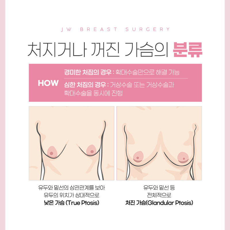 Breast Lift Surgery Cost: An Appropriate Method for Sagging Breasts? image 3