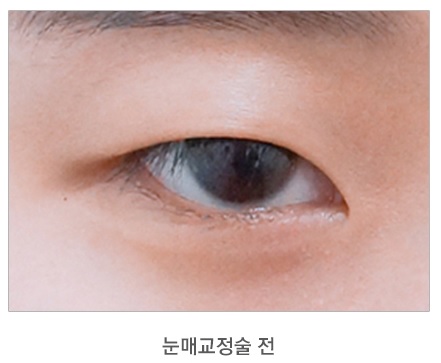졸려 보이는 눈, 답답한 눈매 JW정원성형외과 눈매교정술로! 관련 이미지 1