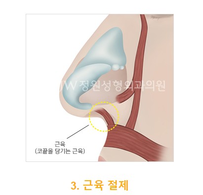 The Main Cause of a Long Nose in Aging! Making a Youthful Look with a Hooked Nose and Long Nose Surgery image 6