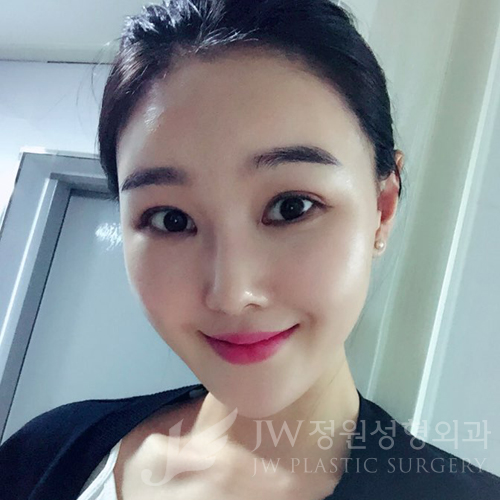 이마눈썹리프팅,눈매교정술,앞트임복원,코성형,지방이식 &rArr; JW정원성형외과에서! 관련 이미지 13
