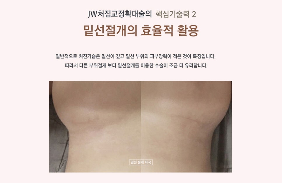 처진정도, 높이, 위치, 비대칭 등을 고려한 JW 처진가슴수술 관련 이미지 5