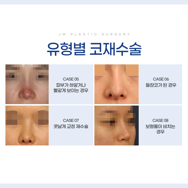 Nose Revision Surgery Review: Careful Work to Avoid Further Side Effects image 3