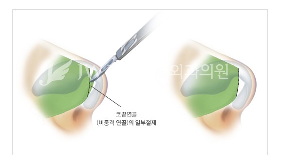 The Main Cause of a Long Nose in Aging! Making a Youthful Look with a Hooked Nose and Long Nose Surgery image 7