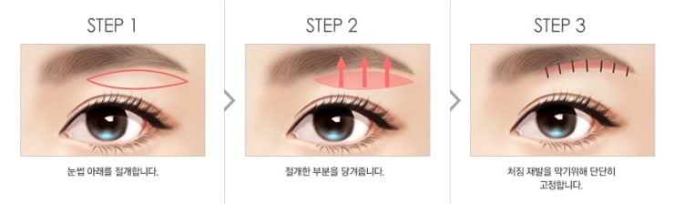 처진 눈꺼풀, 상안검 성형으로 시야 개선과 젊은 눈매를 동시에! 관련 이미지 4
