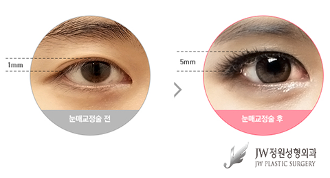 피곤해보이는 졸린 눈을 생기 있게 바꾸는 눈매교정술 관련 이미지 1