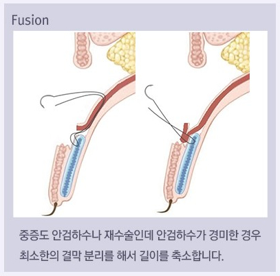 Ptosis Double Eyelid Surgery: Different Eye-Correction Methods Depending on the Degree image 5