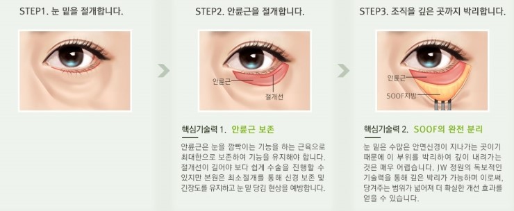Three-Dimensional Under-Eye Contours Can Be Restored to How They Looked 10 Years Ago with Lower Blepharoplasty image 6