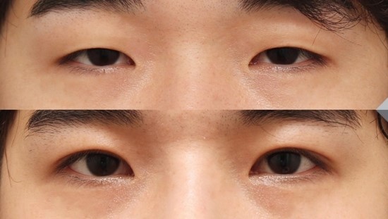 티안나는 자연스러움! JW정원성형외과 남자쌍꺼풀 관련 이미지 3