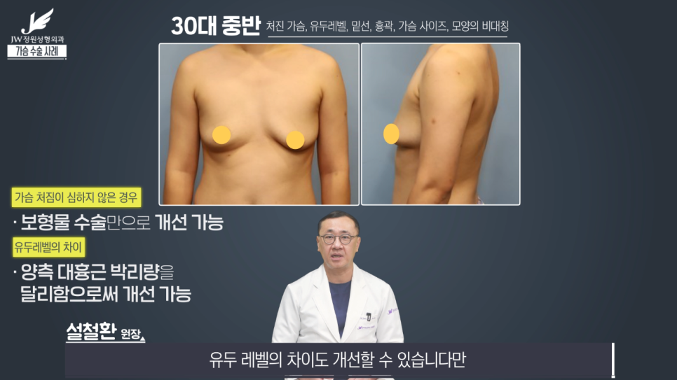 처진가슴교정 치밀한 계획으로 완성도는 UP! 【강남 JW정원성형외과】 관련 이미지 5