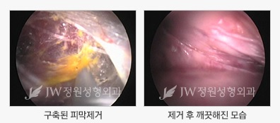 안전함과 아름다움을 동시에! JW정원성형외과 가슴재수술 관련 이미지 3