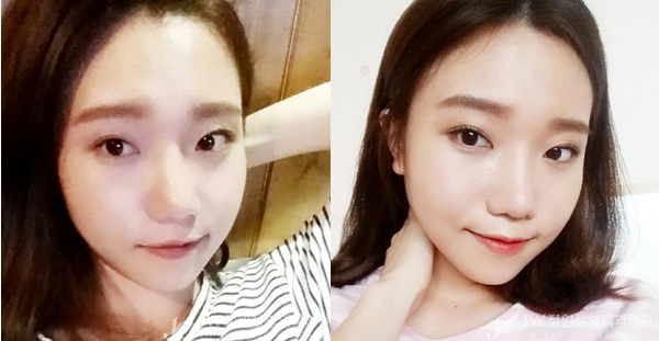 밋밋한 얼굴에서 상큼하고 매력적인 얼굴로♡JW정원 코+윤곽성형 관련 이미지 3