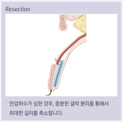 Ptosis Double Eyelid Surgery: Different Eye-Correction Methods Depending on the Degree image 6