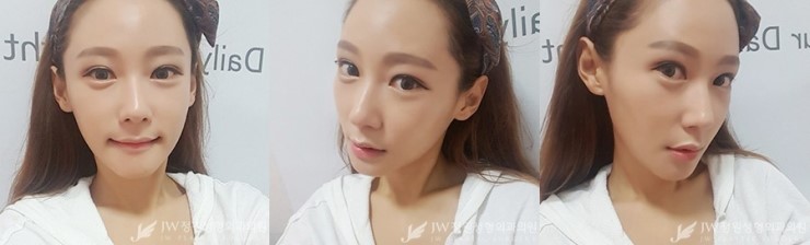 [JW정원성형외과] 턱끝재수술, 비절개눈매교정으로 동안 완성♡ 리얼셀카 관련 이미지 3