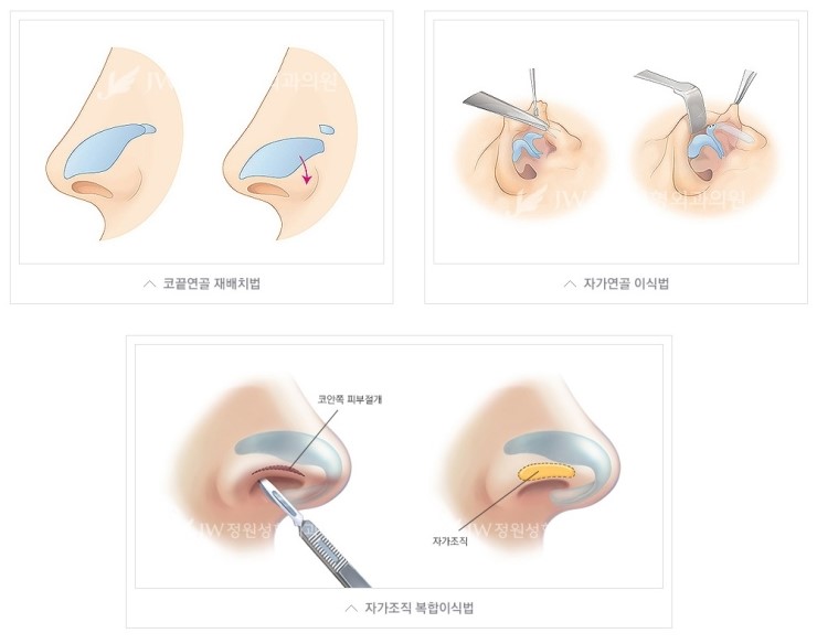 얼굴의 조화를 살린 JW정원성형외과 들창코, 짧은코 성형 관련 이미지 5