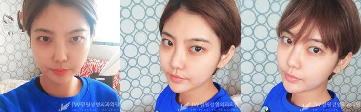 울퉁불퉁한 얼굴라인&rarr;JW정원지방이식으로 매끈하게! 관련 이미지 3