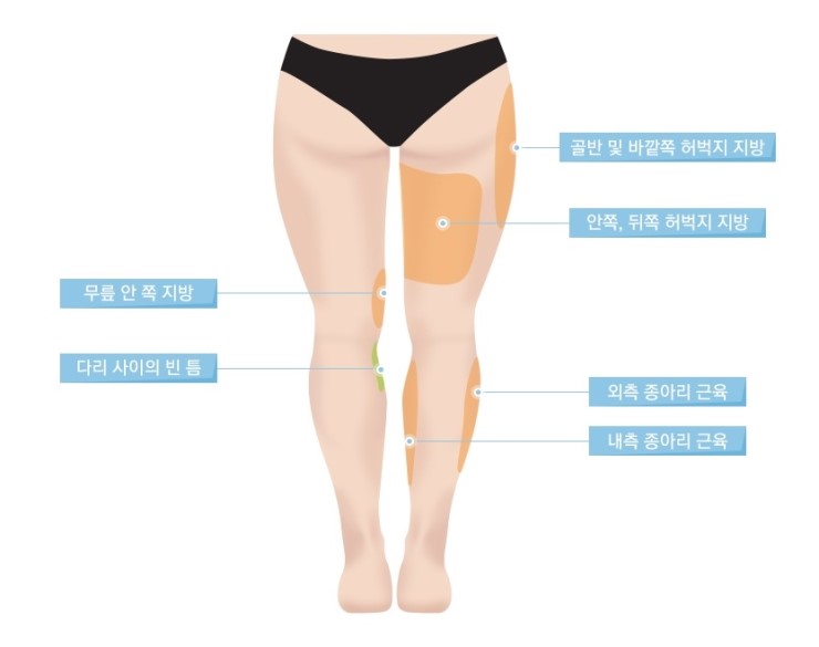 두꺼운 허벅지, 울퉁불퉁 종아리알! JW정원성형외과 모델핏 다리교정으로 매끈하고 날씬하게! 관련 이미지 3