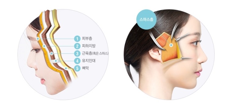 [JW정원성형외과] 안면거상술로 동안완성! 안면거상잘하는병원 관련 이미지 2