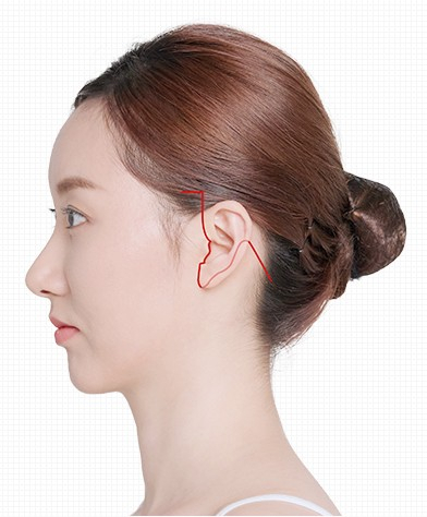 미니거상과 전체 안면거상, 나에게 맞는 안면거상술은? 관련 이미지 4