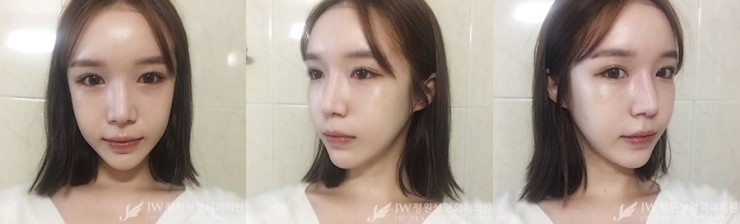 [JW정원성형외과] 지방이식+코재수술로 입체감 있는 얼굴완성♡ 관련 이미지 3